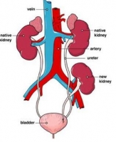 Tx kidney.jpg